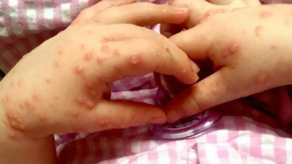 Tamaulipas ya registra 71 brotes de virus manos, pies y boca; es Tampico quien concentra la mayoría de casos