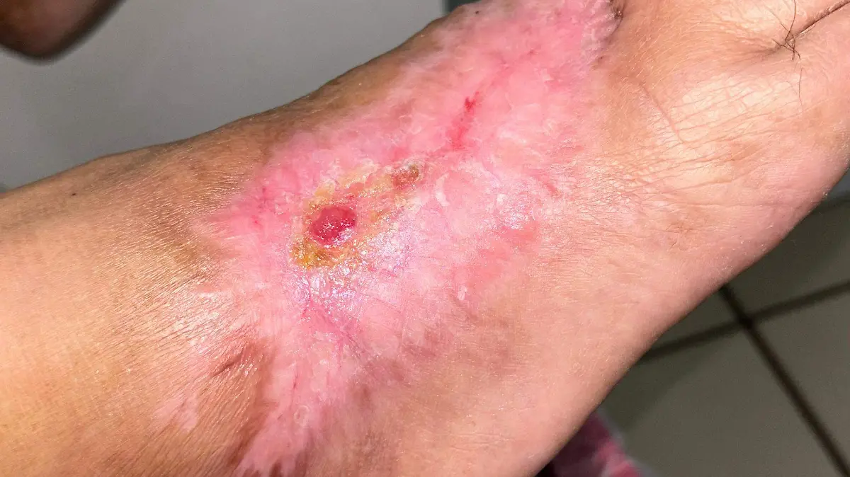 Pie diabético: una amenaza que puede terminar en amputación