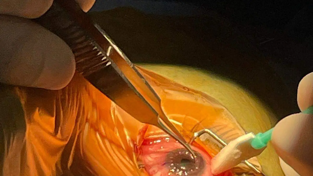 Exitosos dos primeros trasplantes de córnea en Tlaxcala