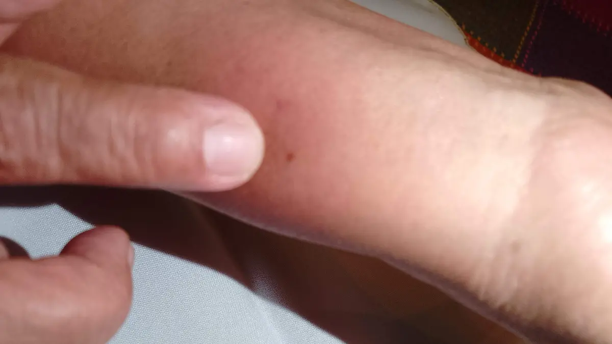PICADURA DE ARANA VIUDA NEGRA