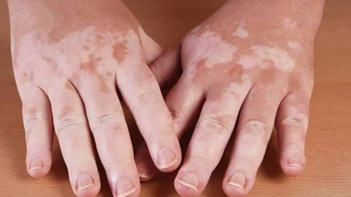 vitiligo