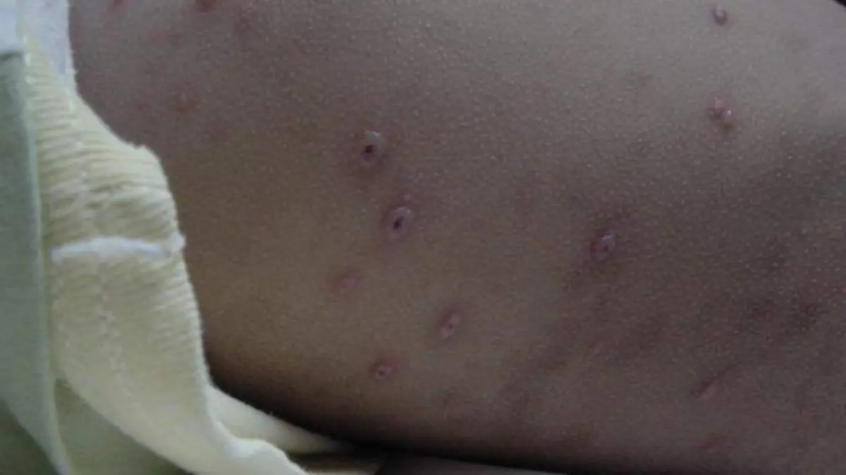 varicela1