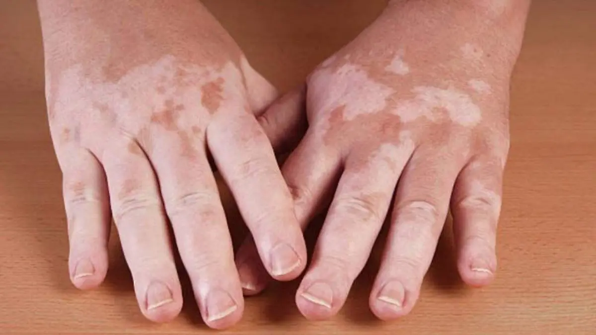 vitiligo