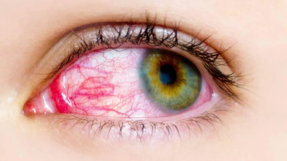 conjuntivitis-ficha_1dee1e5c_1280x720