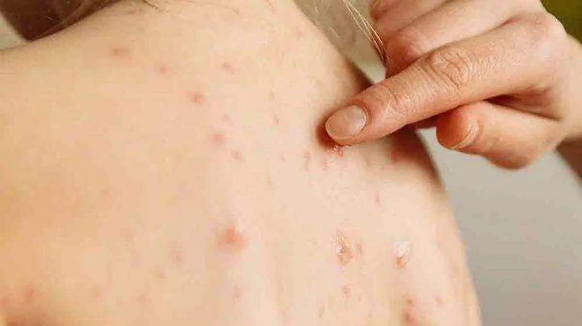 culebrilla-una-enfermedad-comun-que-se-activa-c-849506-520248-jpg_604x0