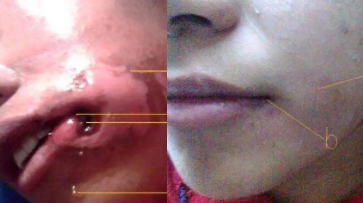 Cicatrización