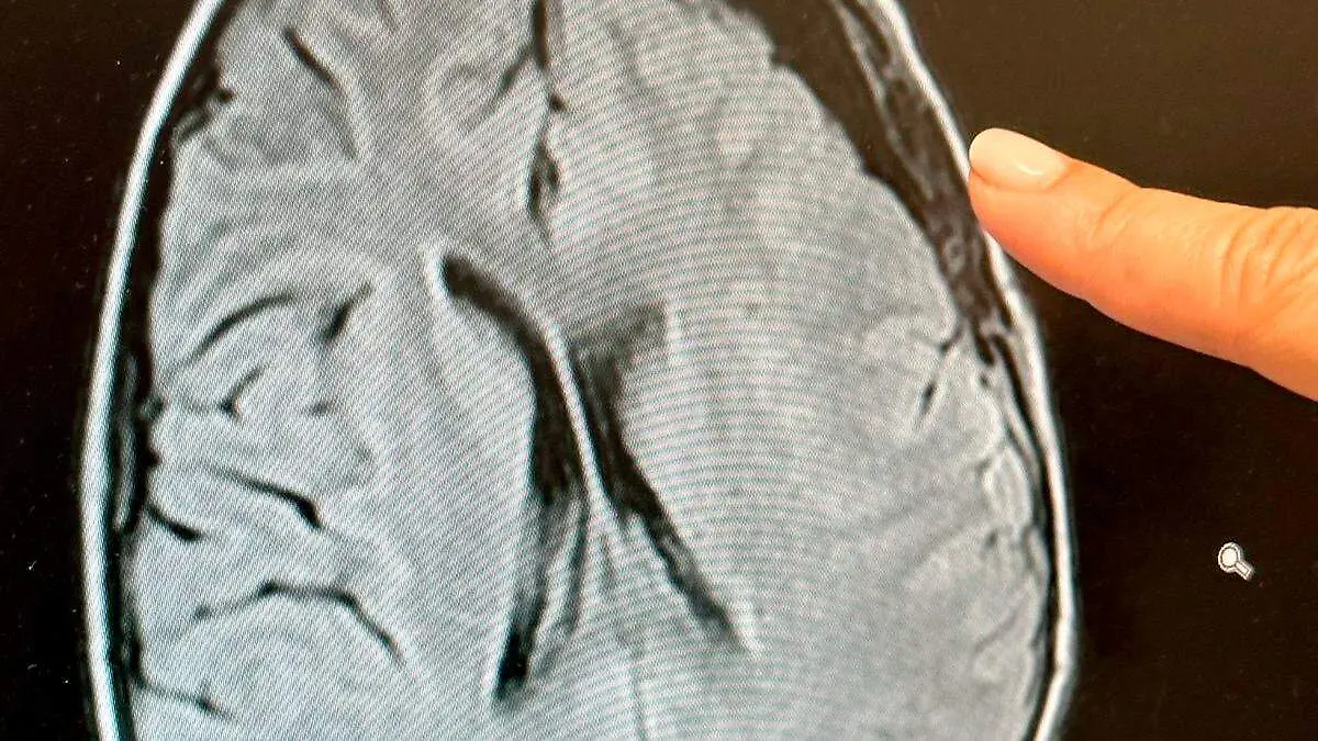 Radiografía de un cerebro