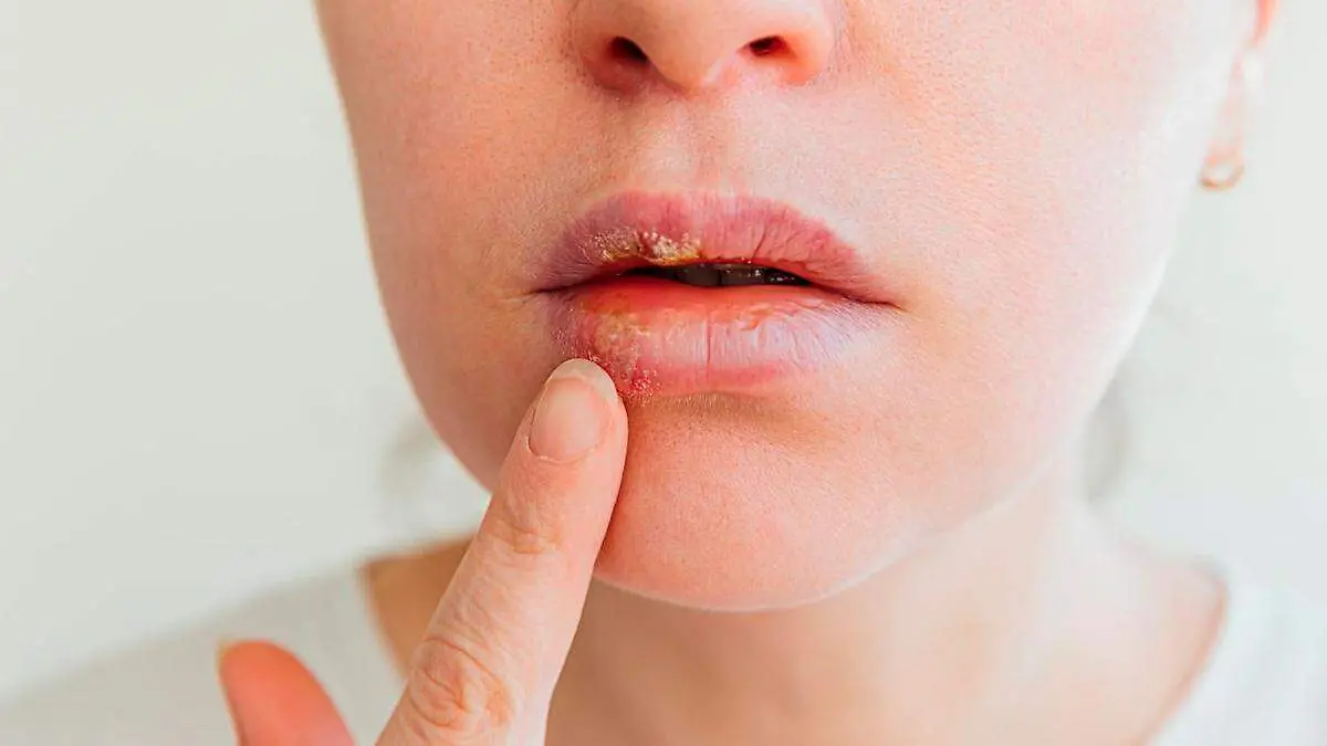 Herpes labial