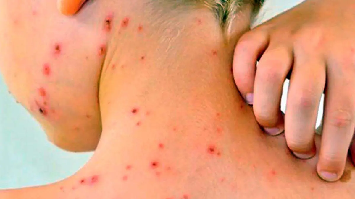 Persona con sarampión