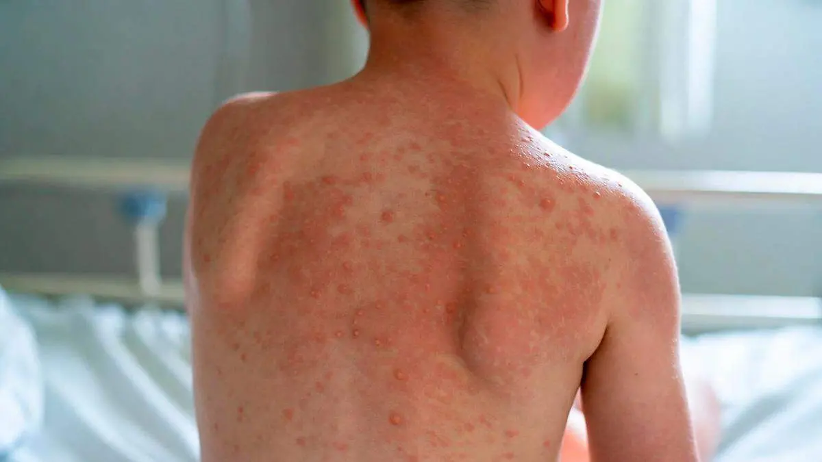 Imagen ilustrativa de un paciente con sarampión