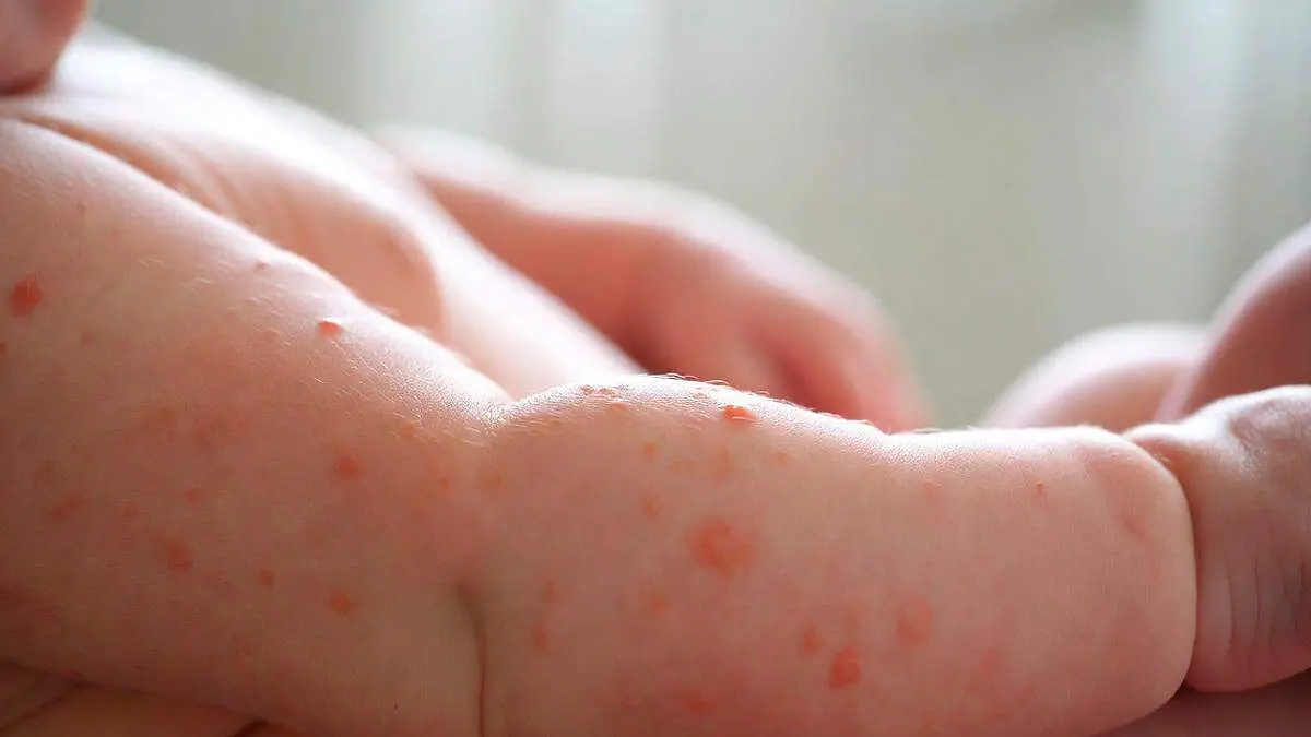 Imagen de bebé con síntomas de sarampión