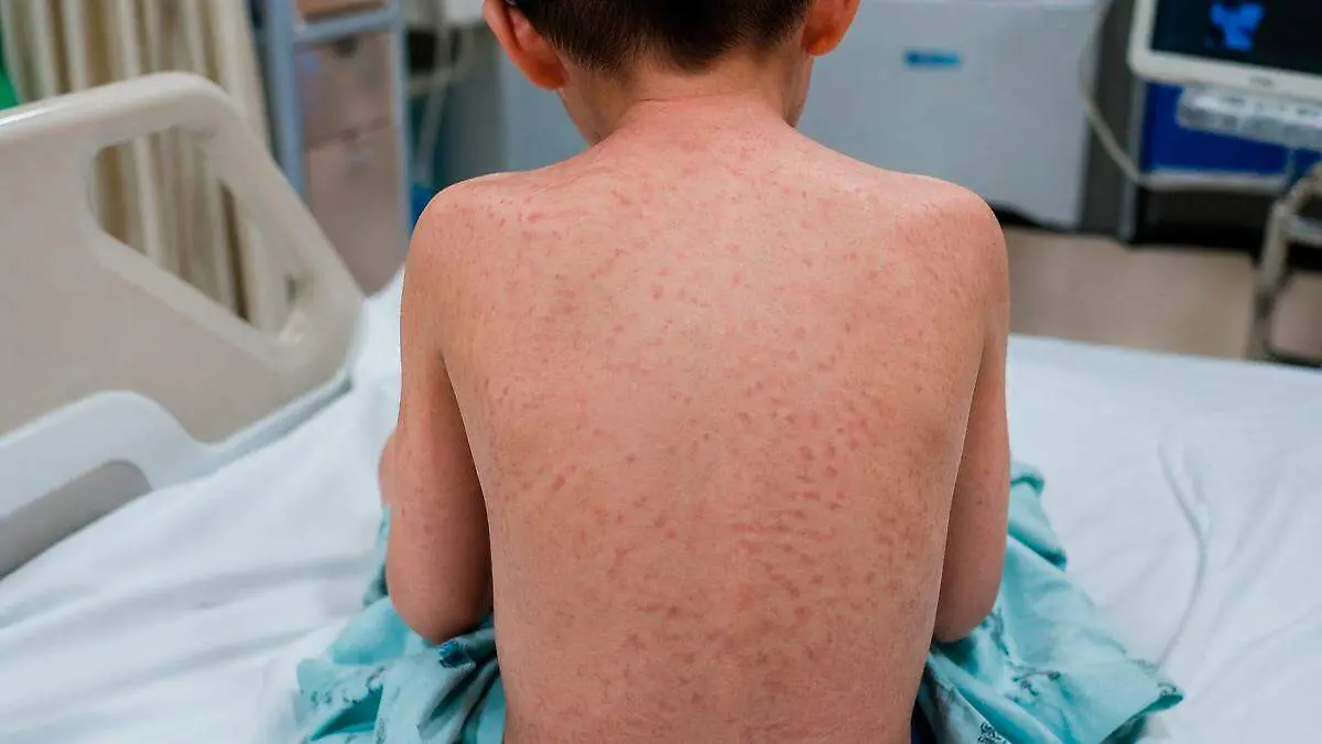 Niño con sarampión