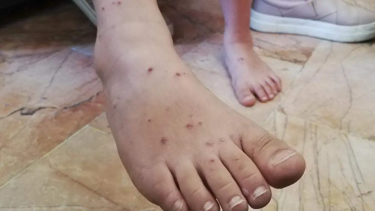 Píe de una persona con síntomas de varicela