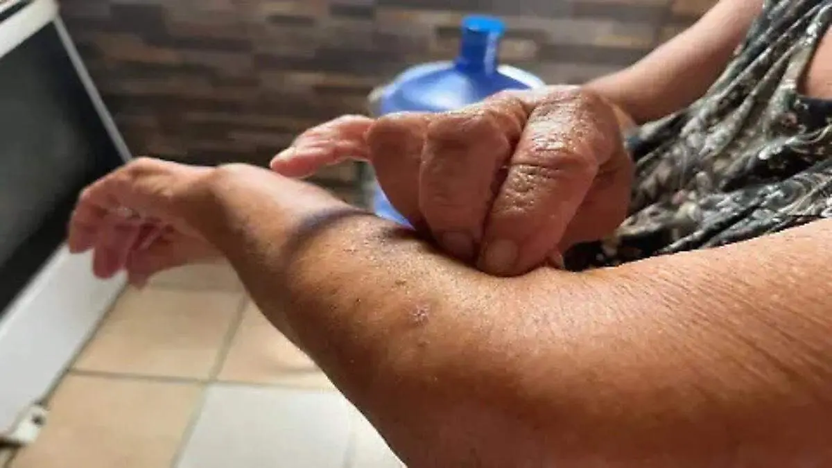 picadura-garrapata-brazo-mujer