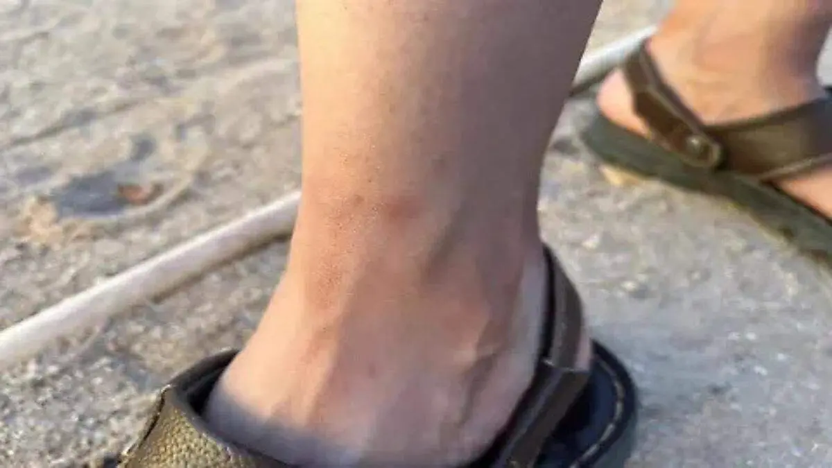 picadura-garrapata-pie