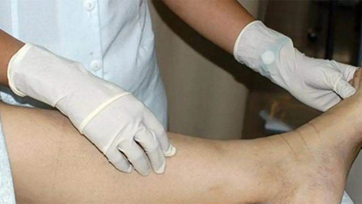 imss-rehabilitación