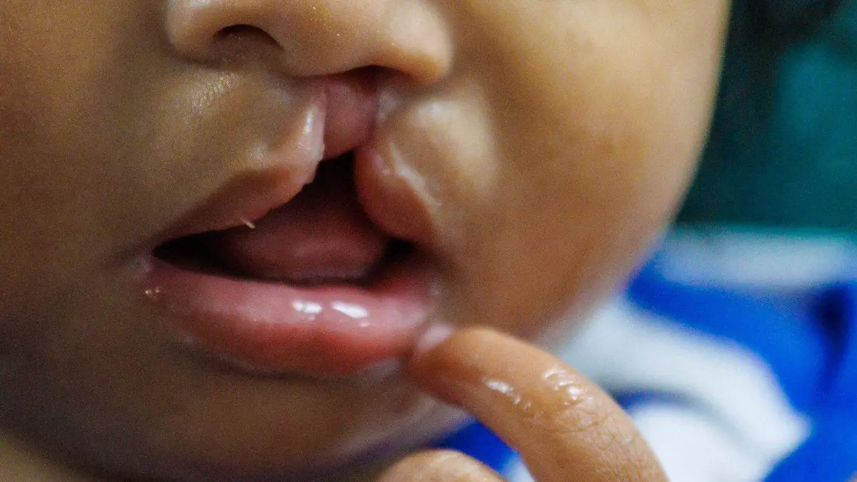 Vuelven médicos de Interface con programa de cirugías gratuitas