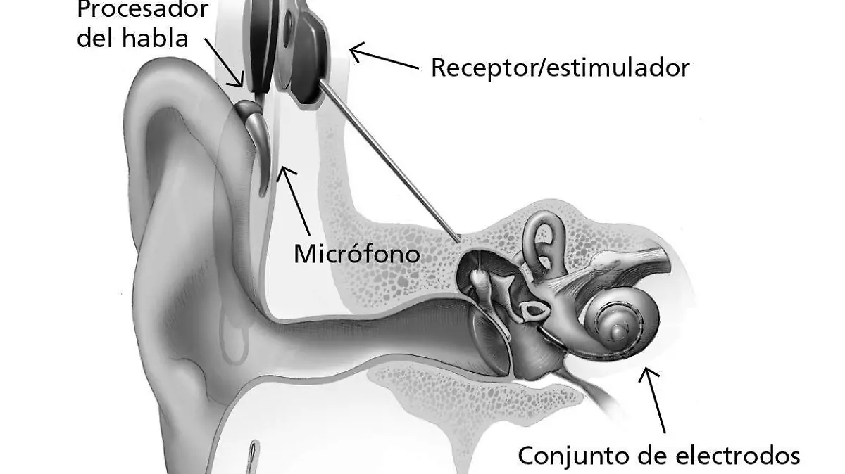 Implante coclear ilustración