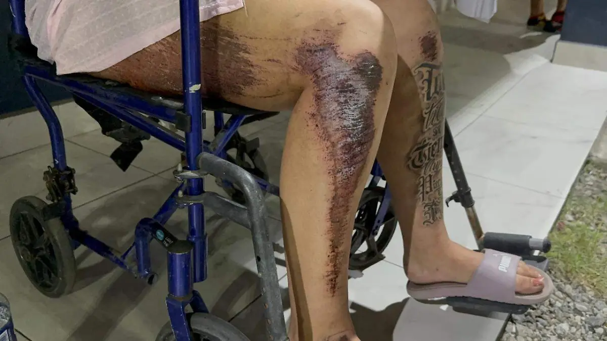 Atropellan a mujer de forma intencional y afirma que no le permitieron denunciar 