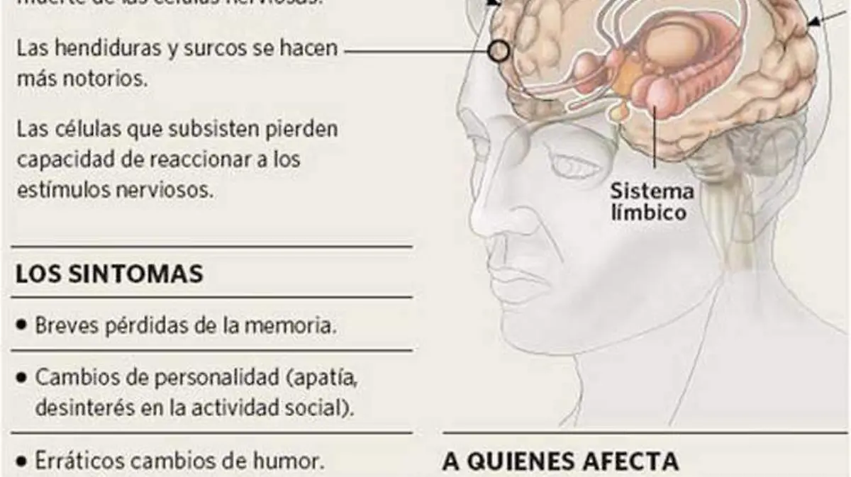 informacion-alzheimer